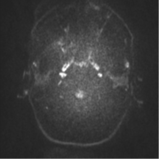 Anaplastic oligodendroglioma (Radiopaedia 37667-39563 Axial DWI 62).png