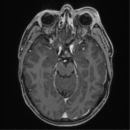 Anaplastic oligodendroglioma with skull fracture (Radiopaedia 74831-85845 Axial T1 C+ fat sat 22).png