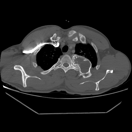 Aneurysmal bone cyst - rib (Radiopaedia 82167-96220 Axial bone window 68).jpg