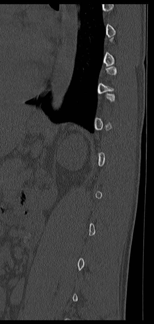 Aneurysmal bone cyst T11 (Radiopaedia 29294-29721 Sagittal bone window 19).jpg