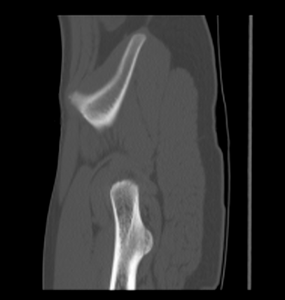 Aneurysmal bone cyst of ischium (Radiopaedia 25957-26094 Sagittal bone window 62).png