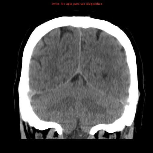 File:Aneurysmal subarachnoid hemorrhage (Radiopaedia 24740-24997 Coronal non-contrast 37).jpg