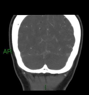 File:Aneurysmal subarachnoid hemorrhage with intra-axial extension (Radiopaedia 84371-99732 C 20).jpg