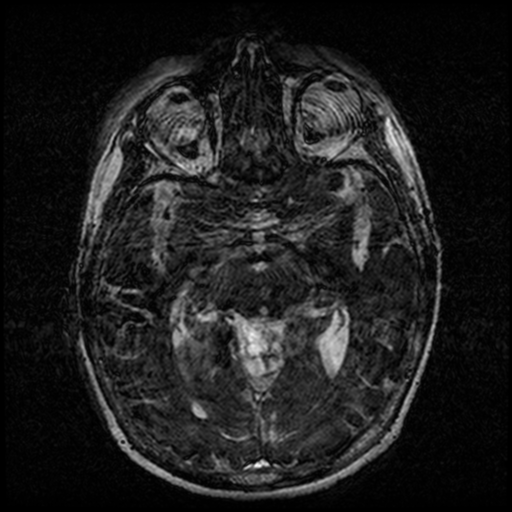 Angioinvasive aspergillosis in the pituitary fossa (Radiopaedia 39676-42010 Ax 3D FIESTA VOLUME 76).png