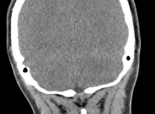 Angular dermoid cyst (Radiopaedia 88967-105790 Coronal non-contrast 103).jpg