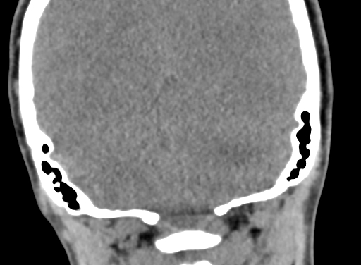 Angular dermoid cyst (Radiopaedia 88967-105790 Coronal non-contrast 97).jpg