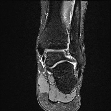 Ankle syndesmotic injury (Radiopaedia 69066-78837 Coronal PD fat sat 24).jpg