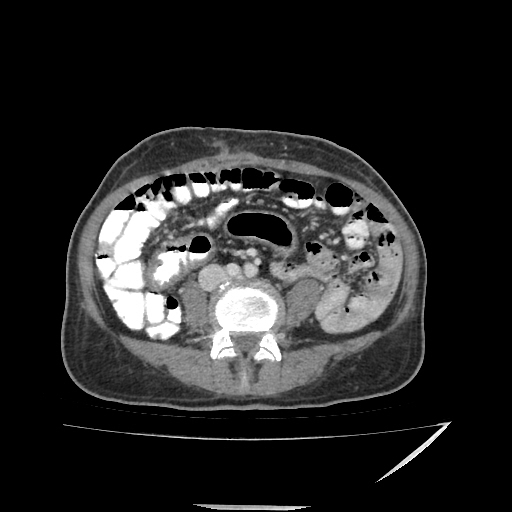 Anorectal carcinoma (Radiopaedia 44413-48064 A 33).jpg