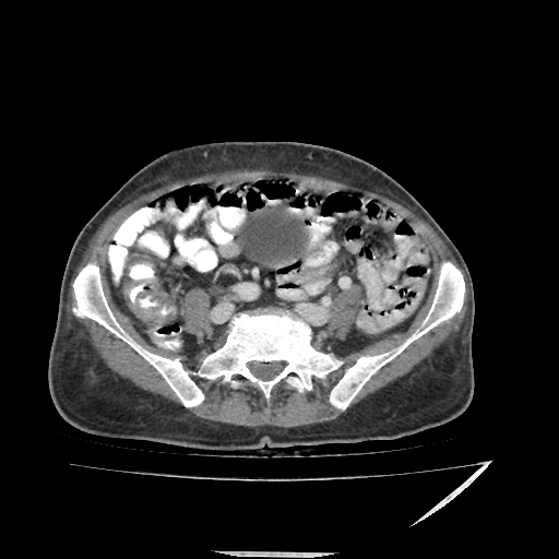 Anorectal carcinoma (Radiopaedia 44413-48064 A 38).jpg