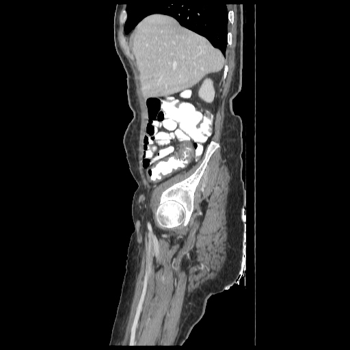 File:Anorectal carcinoma (Radiopaedia 44413-48064 C 16).jpg