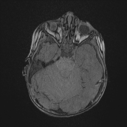 Anoxic brain injury (Radiopaedia 79165-92139 Axial MRA 69).jpg