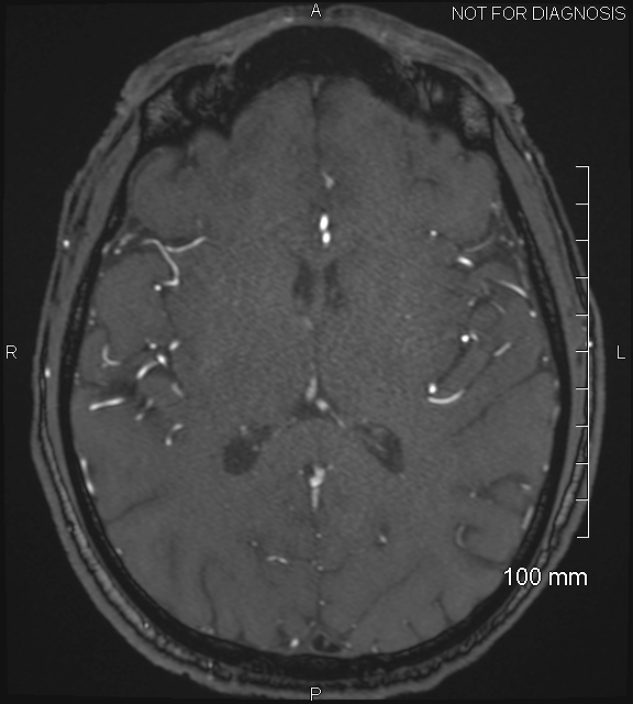 Anterior cerebral artery aneurysm (Radiopaedia 80683-94127 Axial MRA 136).jpg