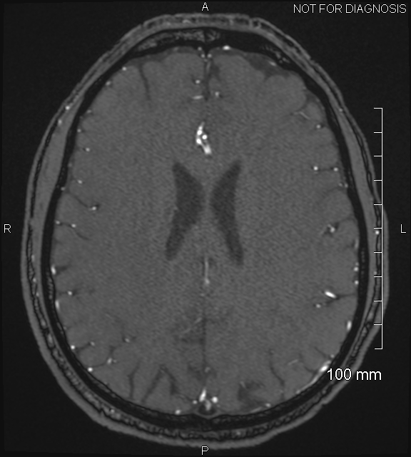 Anterior cerebral artery aneurysm (Radiopaedia 80683-94127 Axial MRA 164).jpg