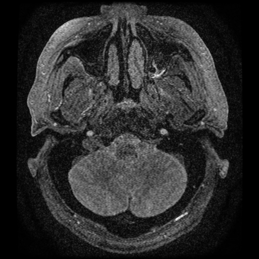 Anterior cerebral artery infarction (Radiopaedia 46794-51323 Axial MRA 2).jpg