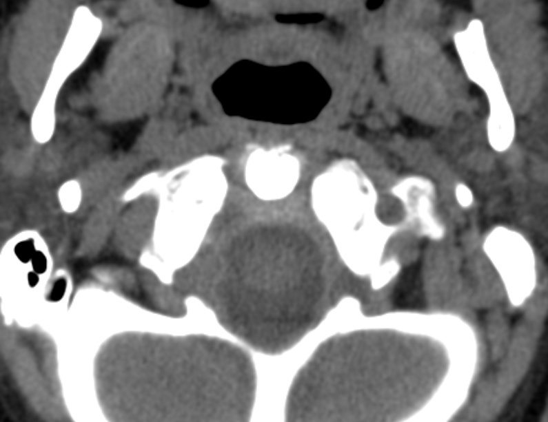 Anterior cervical postdiscectomy arthrodesis (Radiopaedia 32678-33646 Axial non-contrast 12).jpg