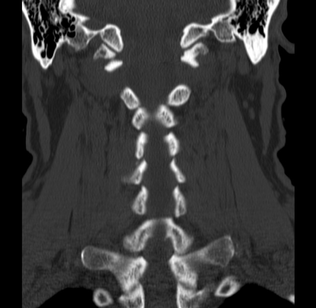 Anterior cervical postdiscectomy arthrodesis (Radiopaedia 32678-33646 Coronal bone window 42).jpg