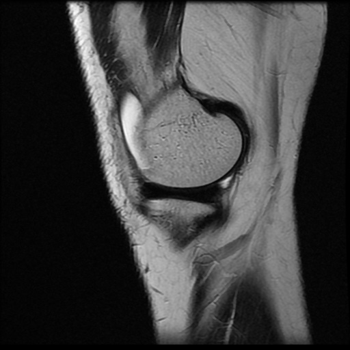 File:Anterior cruciate ligament avulsion fracture (Radiopaedia 58939-66193 Sagittal T2 18).jpg