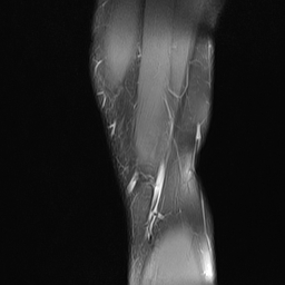 File:Anterior cruciate ligament full thickness tear (Radiopaedia 66268-75467 Sagittal PD fat sat 2).jpg