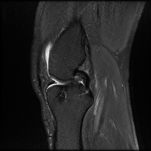 File:Anterior cruciate ligament graft tear and bucket-handle tear of medial meniscus (Radiopaedia 75867-87254 Sagittal PD fat sat 12).jpg