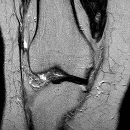 File:Anterior cruciate ligament mucoid degeneration (Radiopaedia 60853-68633 Coronal T2 12).jpg