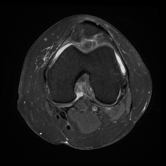 File:Anterior cruciate ligament tear, Wrisberg rip and bucket-handle tear of medial meniscus (Radiopaedia 75872-87266 Axial PD fat sat 15).jpg