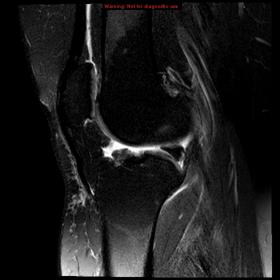 File:Anterior cruciate ligament tear (Radiopaedia 12329-12612 E 10).jpg