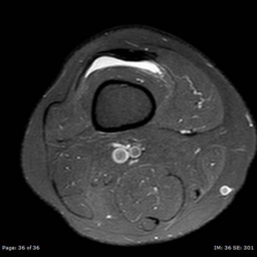 File:Anterior cruciate ligament tear (Radiopaedia 70783-80964 Axial PD fat sat 36).jpg