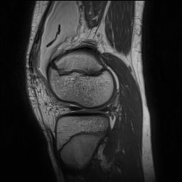 Anterior cruciate ligament tear - pediatric (Radiopaedia 62152-70260 Sagittal PD 129).jpg
