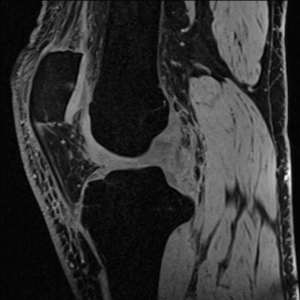Anterior cruciate ligament tear - ramp lesion (Radiopaedia 71883-82322 Sagittal T1 vibe 79).jpg