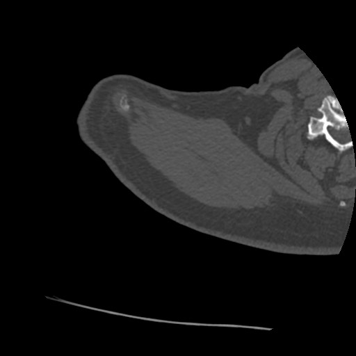 Anterior glenohumeral dislocation with Hill-Sachs lesion (Radiopaedia 62877-71249 Axial bone window 5).jpg