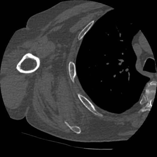 Anterior glenohumeral dislocation with Hill-Sachs lesion (Radiopaedia 62877-71249 Axial bone window 73).jpg
