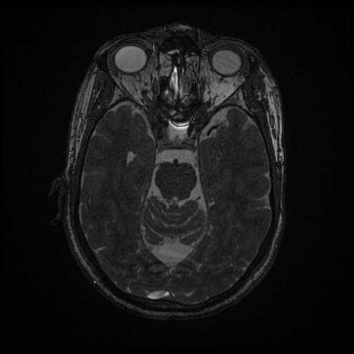 File:Anterior inferior cerebellar artery vascular loop - type II (Radiopaedia 65779).jpg