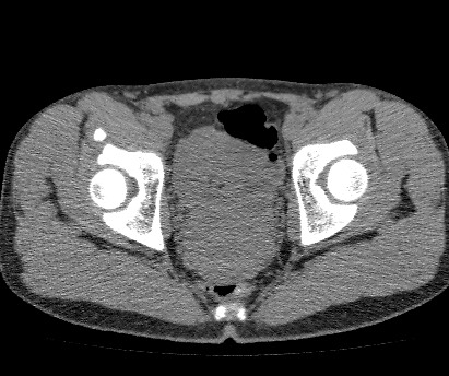 Anterior inferior iliac spine avulsion fracture (Radiopaedia 81312-94999 Axial non-contrast 51).jpg