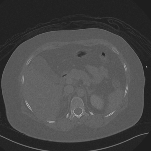 Anterior superior iliac spine avulsion fracture (Radiopaedia 44541-48244 Axial bone window 28).png