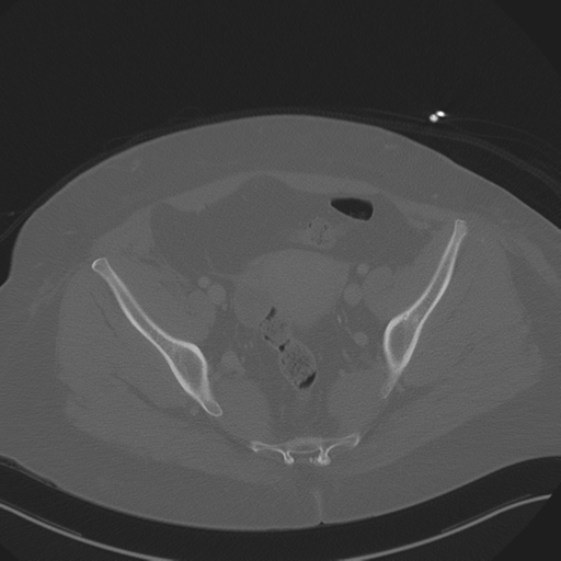 Anterior superior iliac spine avulsion fracture (Radiopaedia 44541-48244 Axial bone window 83).png