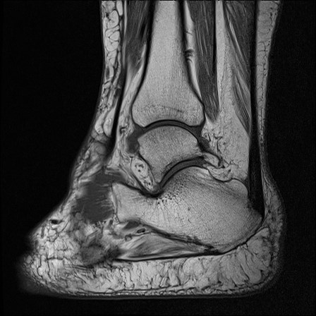 File:Anterior talofibular ligament injury - rupture with soft-tissue impingement (Radiopaedia 38765-40928 Sagittal PD 13).jpg