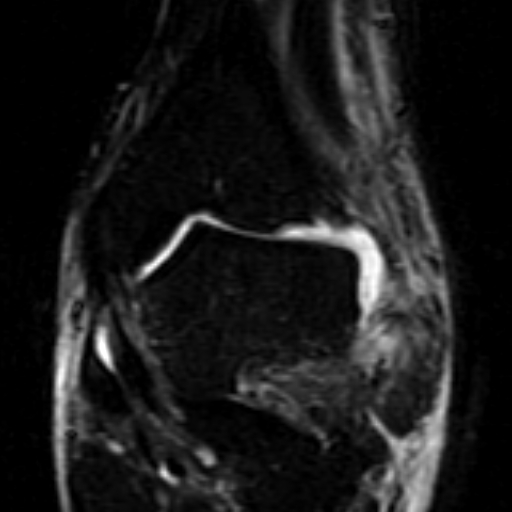 File:Anterior talofibular ligament rupture (Radiopaedia 15831-15484 Coronal STIR 8).jpg