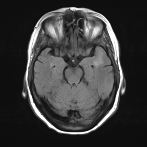 File:Anterior temporal pole cysts (Radiopaedia 46629-51102 Axial FLAIR 10).png