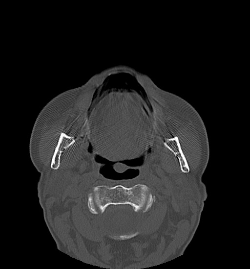 Anterior temporomandibular joint dislocation (Radiopaedia 59430-66784 Axial non-contrast 34).jpg