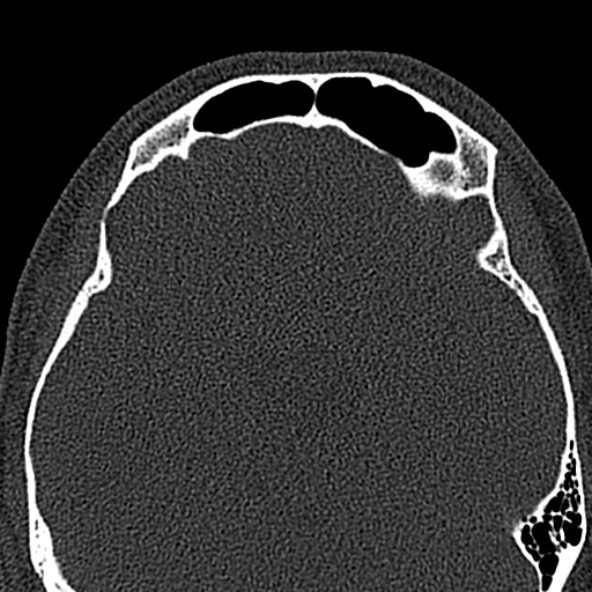 Antrochoanal polyp (Radiopaedia 30002-30554 Axial bone window 50).jpg