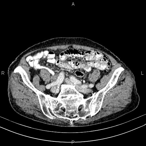 File:Aortic aneurysm and Lemmel syndrome (Radiopaedia 86499-102554 A 61).jpg