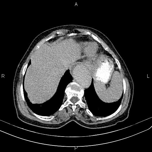 File:Aortic aneurysm and Lemmel syndrome (Radiopaedia 86499-102554 Axial C+ delayed 11).jpg