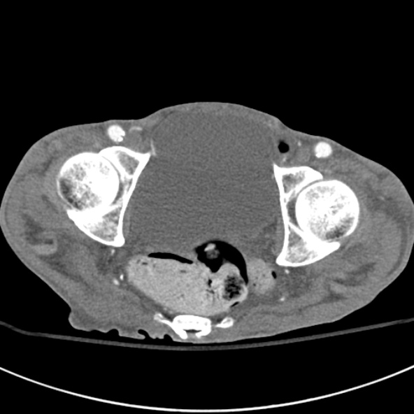 File:Aortic aneurysm with spinal destruction (Radiopaedia 42301-45410 A 103).jpg