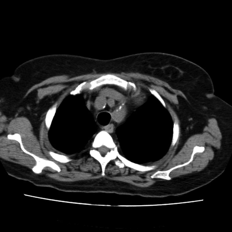 Aortic arch pseudoaneurysm (Radiopaedia 8534-9368 Axial non-contrast 12).jpg