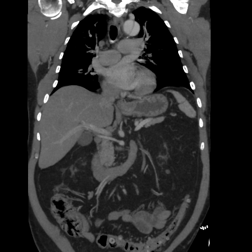 File:Aortic dissection- Stanford A (Radiopaedia 37759-39664 Coronal C+ delayed 23).png