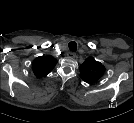 Aortic dissection (CTPA) (Radiopaedia 75506-86751 Axial C+ CTPA 14).jpg