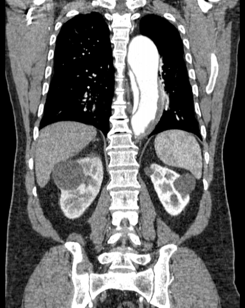 Aortic dissection (Radiopaedia 44411-48061 A 46).jpg