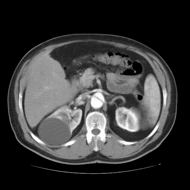 Aortic dissection (Radiopaedia 44411-48061 C 30).jpg