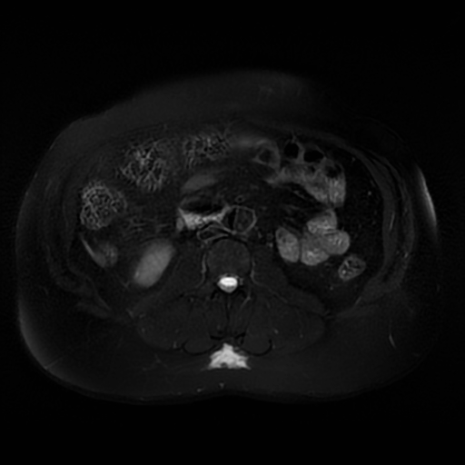 File:Aortic dissection (Radiopaedia 57969-64956 Axial T2 fat sat 39).jpg