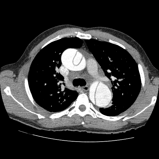 File:Aortic dissection - Stanford A -DeBakey I (Radiopaedia 28339-28587 B 24).jpg